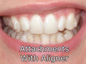 Attachments With Aligner On