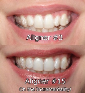 invisalign pain tooth teeth discomfort living aligners braces wearing aligner oh tips months straightening been journey